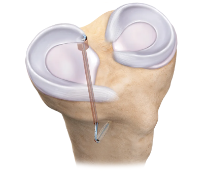 Arthroscopic Meniscus Repair Surgical Excellence