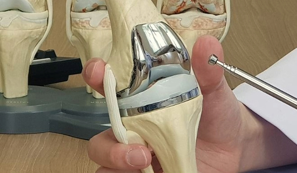 What is Total Knee Replacement?