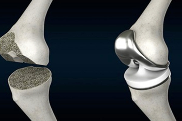 What is Total Knee Replacement?