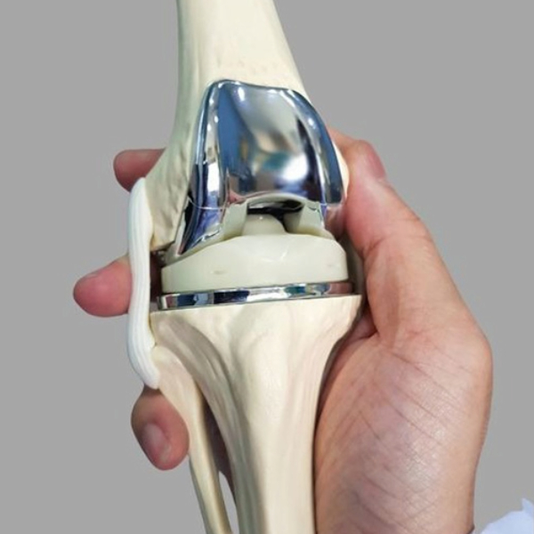 Types of Total Knee Replacement