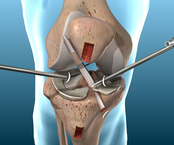 What is Arthroscopic ACL Reconstruction?