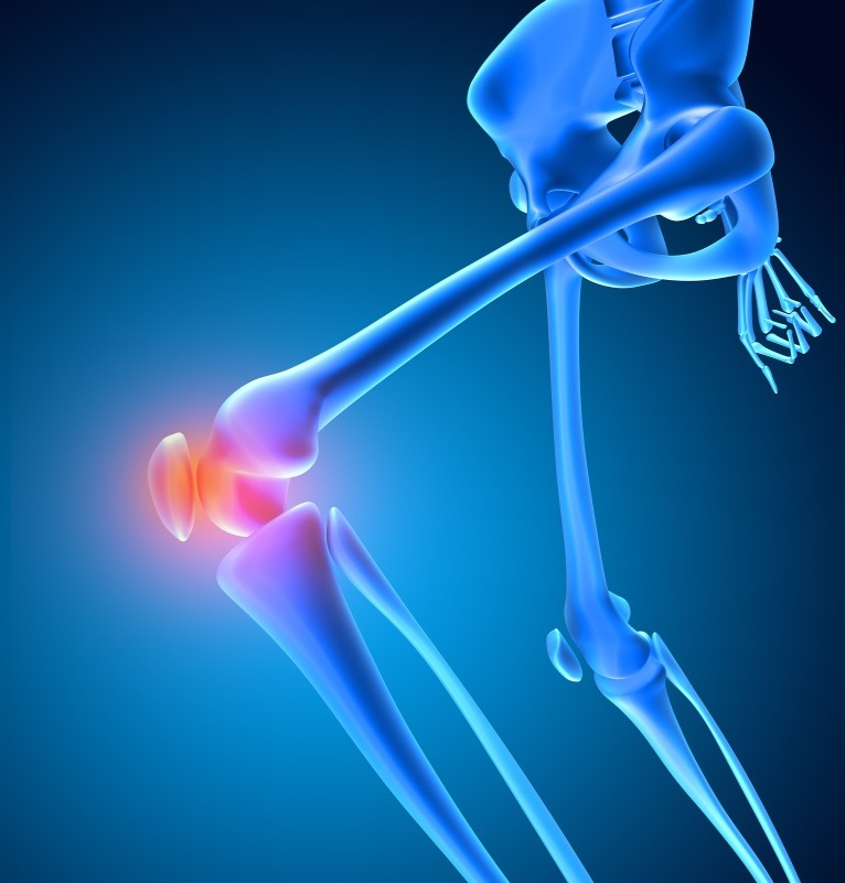 What is Arthroscopic ACL Reconstruction?