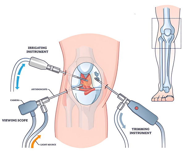 What is Knee Arthroscopic Surgery?