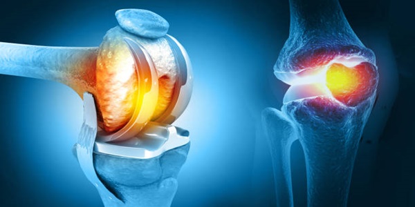 Knee replacement surgery risks