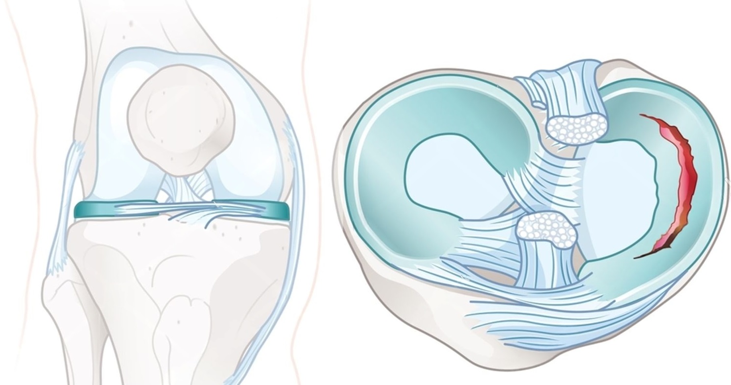 Why Meniscus Surgery is Done