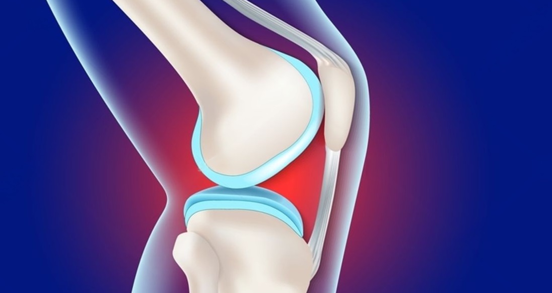 Benefits of Arthroscopic Meniscus Repair