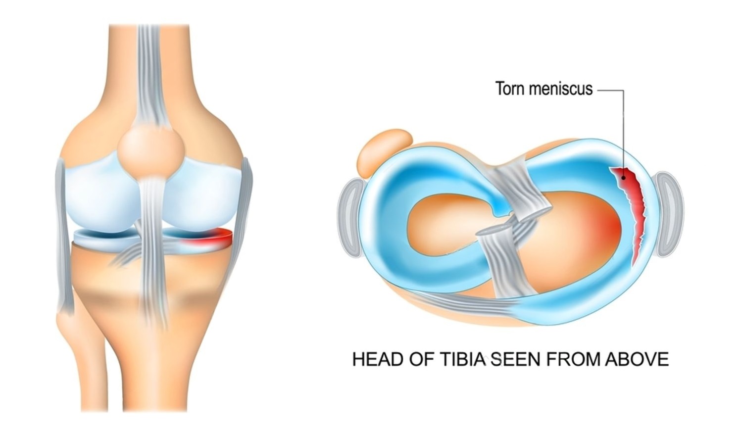 Why Meniscus Surgery is Done