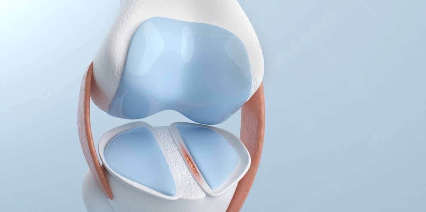 Why Meniscus Surgery is Done