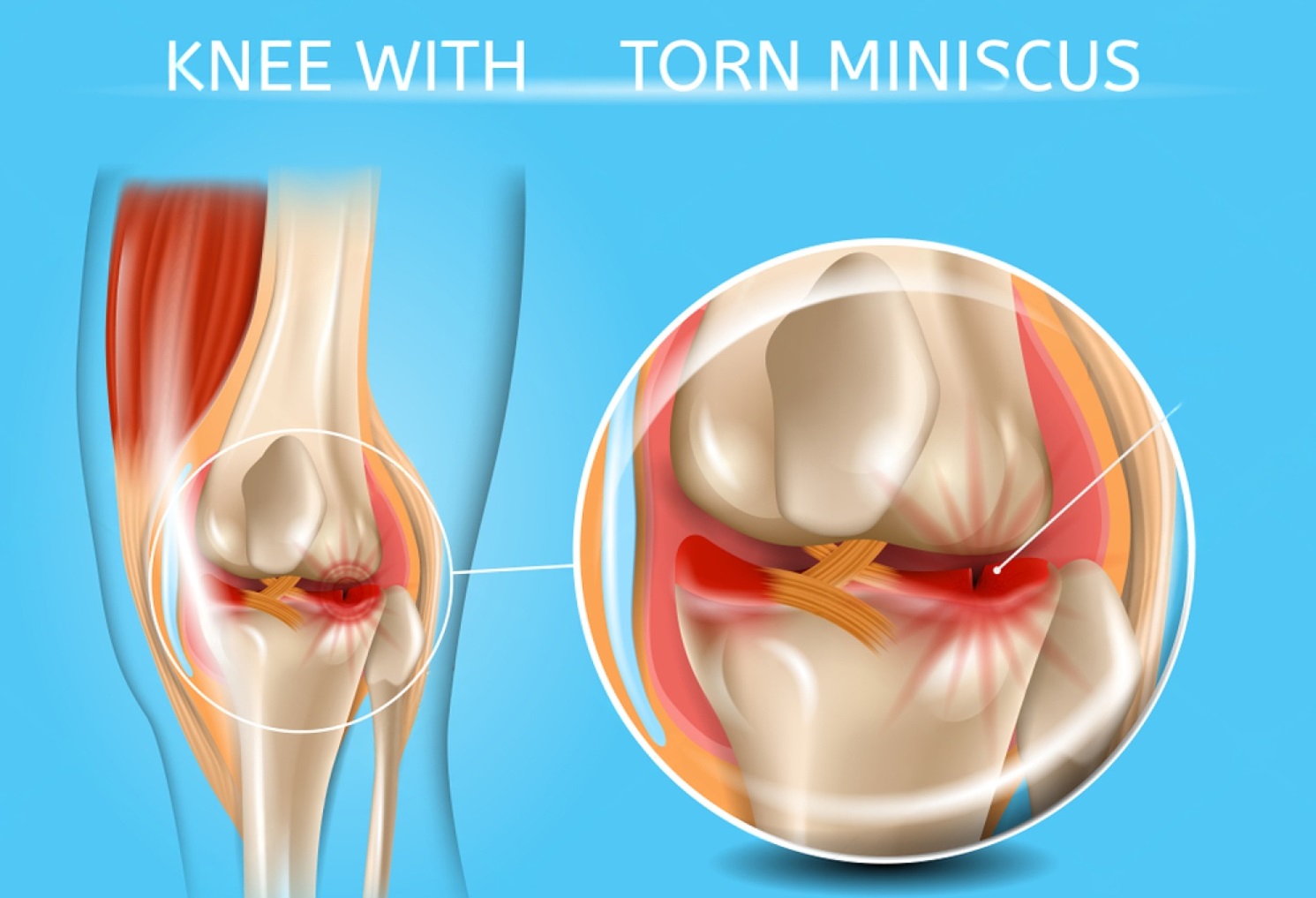 Why Meniscus Surgery is Done