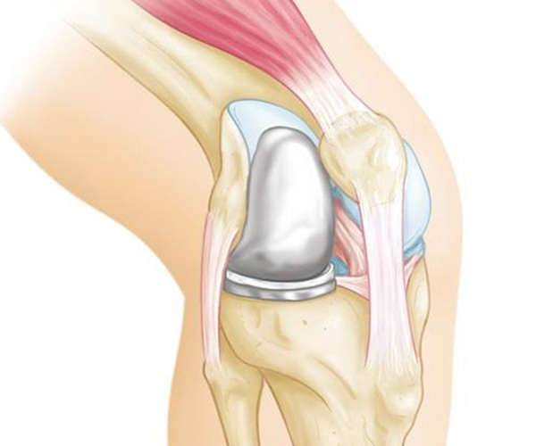 What is Partial Knee Replacement?