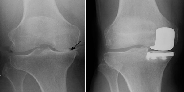 Conditions Treated by Arthroscopic Knee Surgery