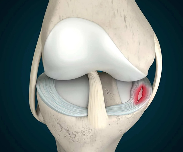 What is Arthroscopic Meniscus Repair?