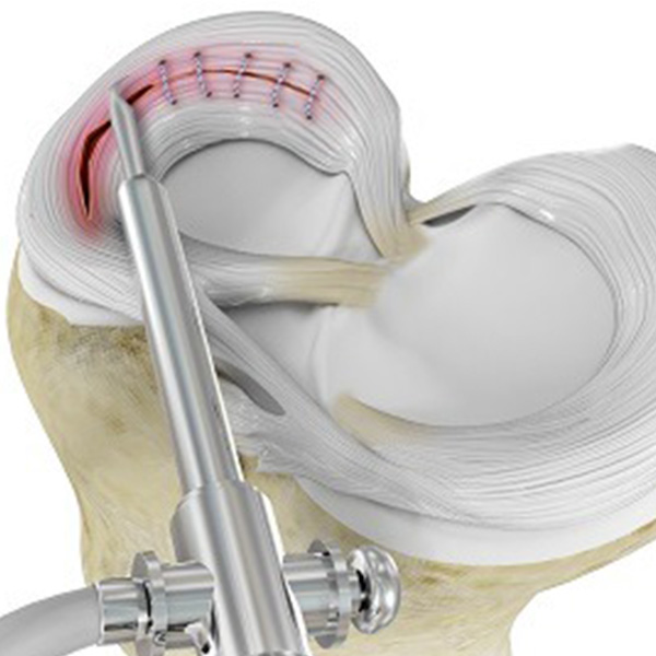 Types of Arthroscopic Meniscus Repair