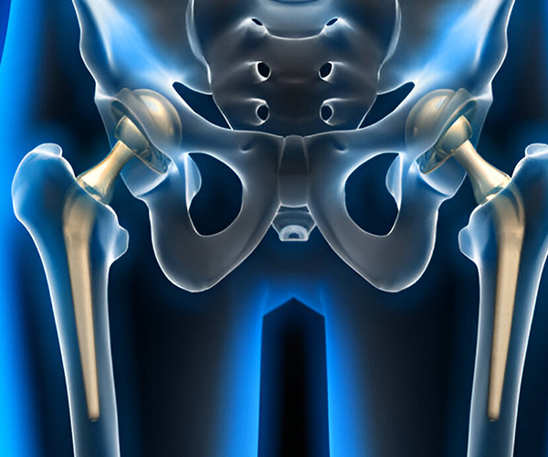 What is Total Hip Replacement?