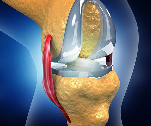 What is Total Knee Replacement?