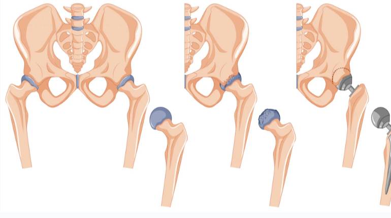 Seven signs you need a hip replacement surgery