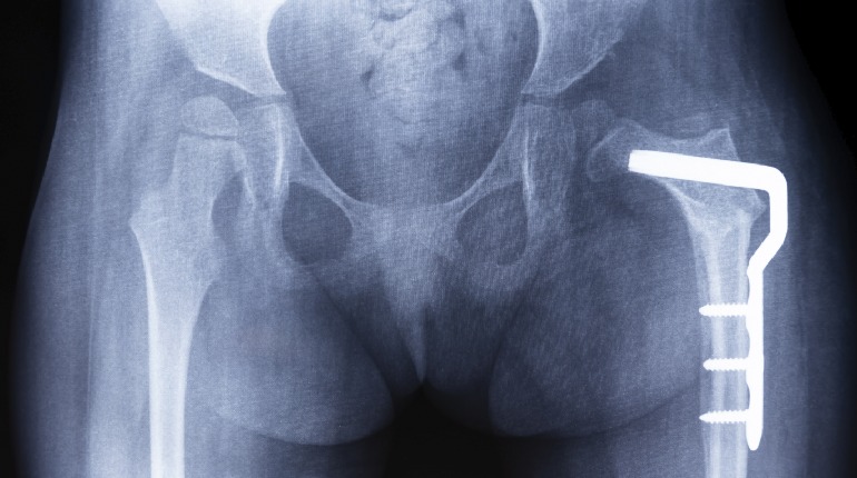 What are the types of acetabular fractures and associated treatment?
