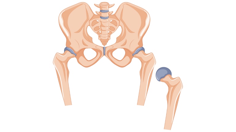 What is AVN of the Hip? Is it Treatable?