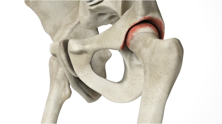 5 Signs You Need a Hip Replacement