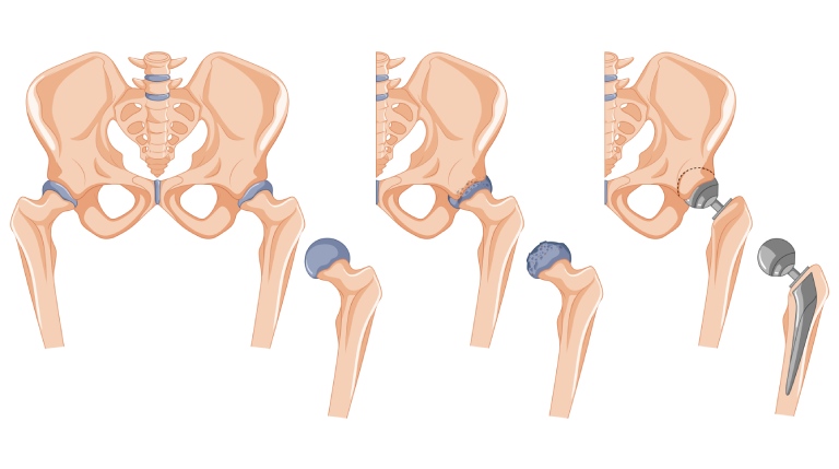 6 Things You Should Know About Treatment of AVN of the Hip