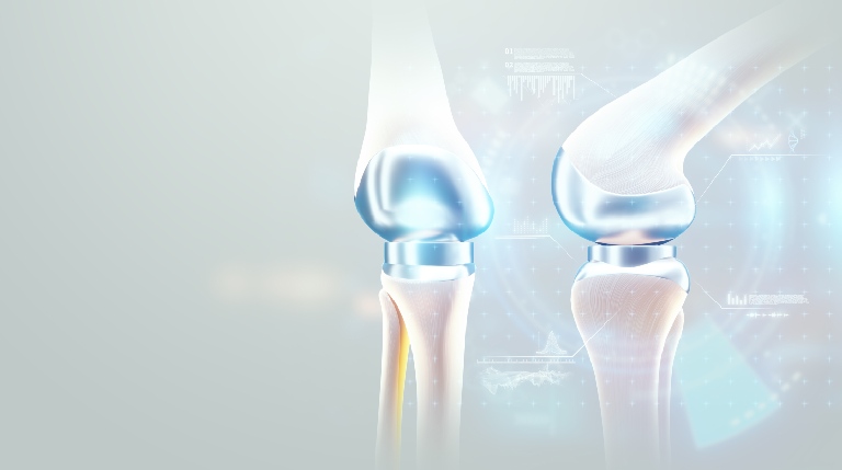 Getting Back to Sports After a Knee Replacement