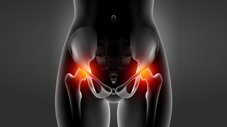 5 Major Causes of Avascular Necrosis (AVN) of the Hip