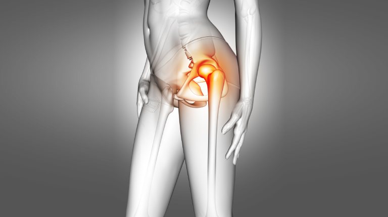 Stages of Avascular Necrosis (AVN) of the Hip: What You Should Know
