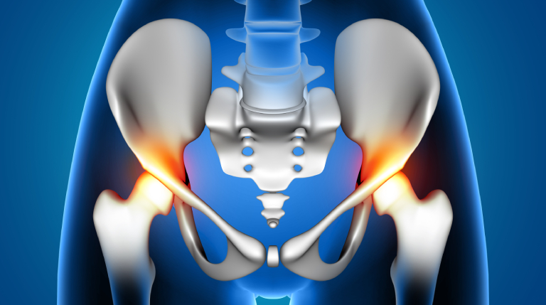 Activities to do after a total hip replacement to get your life back to normal