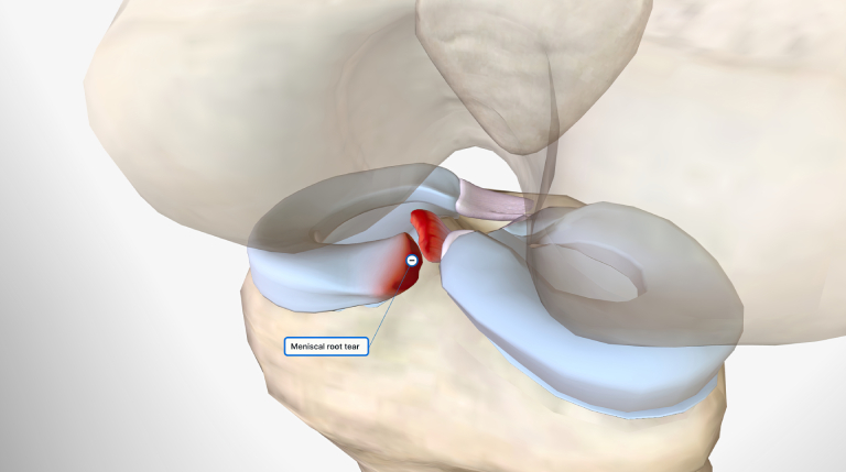 ACL Repair vs. ACL Reconstruction- Understanding the Best Treatment for You
