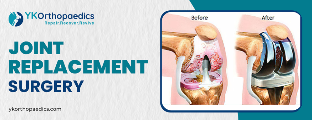 Basics of Joint Replacement Surgery: When Is It Necessary?