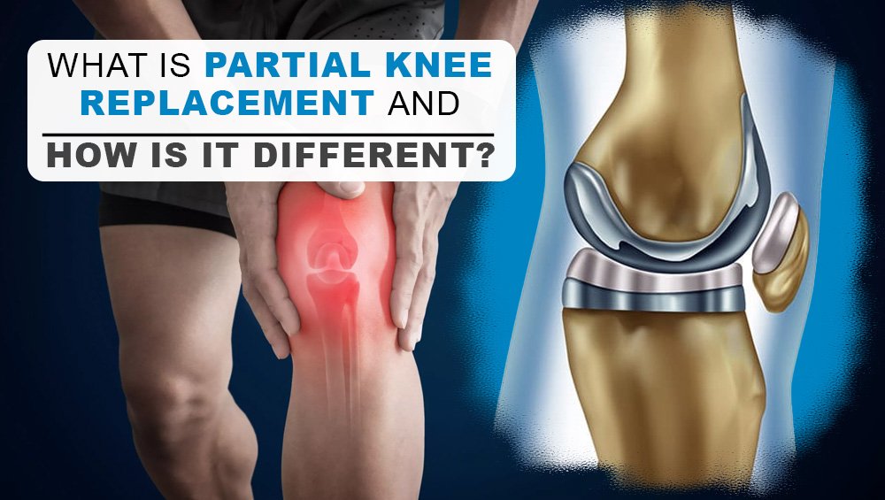 What is Partial Knee Replacement and How Is It Different?