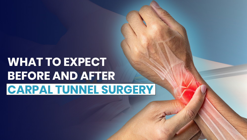 What to Expect Before and After Carpal Tunnel Surgery