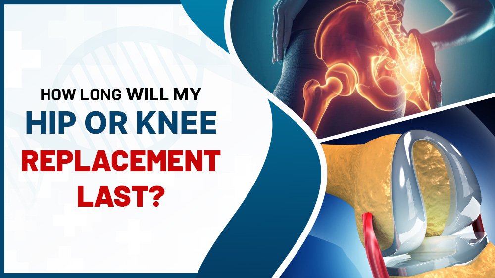 How Long Will My Hip or Knee Replacement Last?