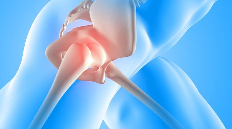 Hip replacement surgery in Gurgaon