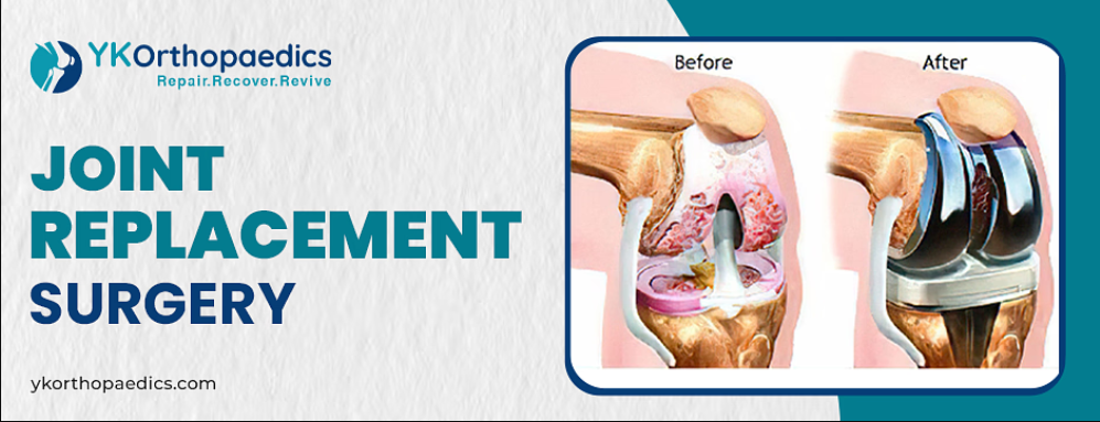 Joint Replacement Surgery